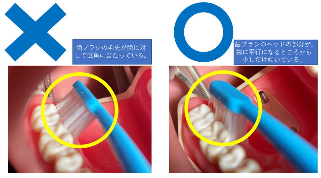 下の奥歯の内側、歯肉の溝の汚れを落とす際の歯ブラシの当て方、一例：医療法人福涛会
