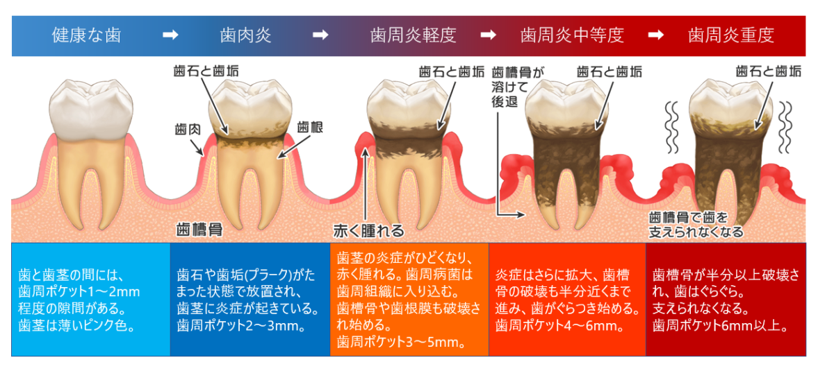 歯周病進行の図　医療法人福涛会
