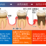 歯周病進行の図　医療法人福涛会