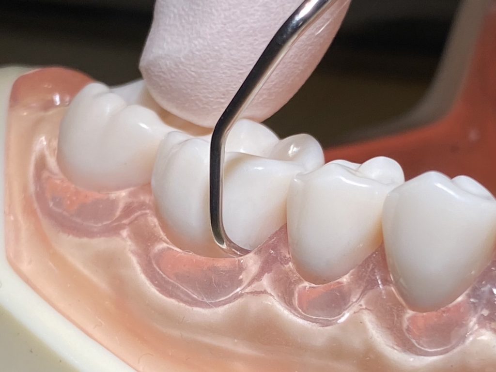 SRP：歯周ポケット内の歯石を専用の器具を使って取り除きます。