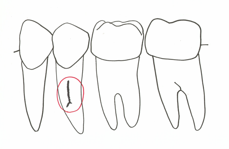 排膿（はいのう）の原因のひとつ、歯根破折（しこんはせつ）って何？教えて歯科衛生士さん！