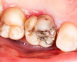 銀歯の除去（金属除去）についての問い合わせと相談が増えている理由