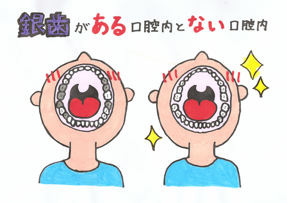 日本だけ？銀歯の現状